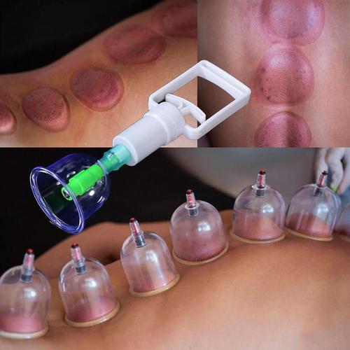 Kit 12 Ventosas + Bomba Ventosa Terapia Massoterapia G3P1 - Kit 12 Ventosas Casa Tech Loja 