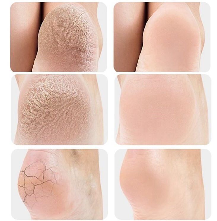 Palmilha Ortopédica para Fascite Plantar, Esporão Ósseo no Calcanhar TER17 - Palmilha Ortopédica para Fascite Plantar, Esporão Ósseo no Calcanhar Casa Tech Loja 